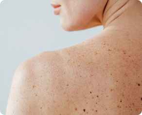 Zmiany skórne i dermatochirurgia