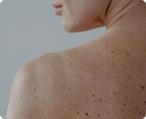 Zmiany skórne i dermatochirurgia>